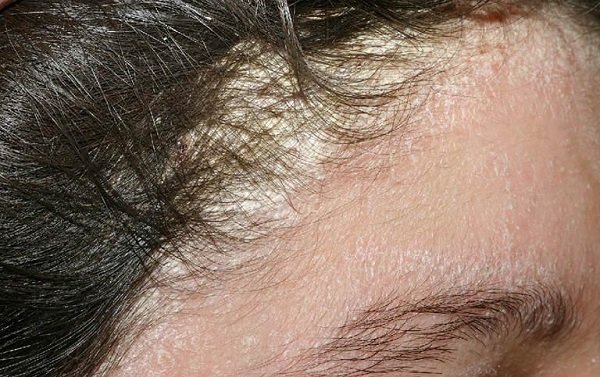 Da đầu bị kích thích quá mức bởi các yếu tố như chải đầu, gội đầu hay massage